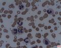 Thrombotic Thrombocytopenic Purpura (TTP)