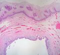 Gartner Duct Cyst (low power)