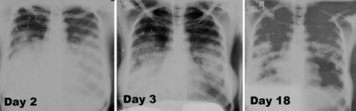 Lungs