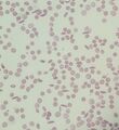 Sickle cell anemia smear
