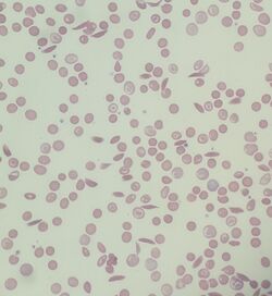 Sickle cell anemia smear