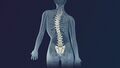 Scoliosis intervertebral disc