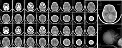 CT brain scan of child with medulloblastoma and resulting hydrocephalus