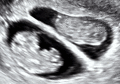 Dichorionic twins with heart activity at 8w5d since co-incubation
