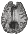 Corpus callosum