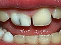 Milk teeth fusion