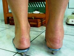 Ankle Joint Arthritis