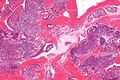 Endometrial stromal condensation