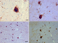 Lewy bodies (alpha synuclein inclusions)