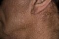 Birt–Hogg–Dubé syndrome