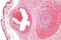 Fetal thrombotic vasculopathy - high magnification