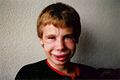 Facial edema