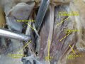 Trochlear nerve