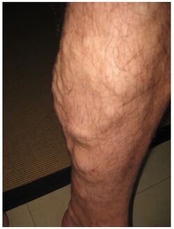 Varicose Vein