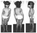 Kyphoscoliosis in hereditary sensory autonomic neuropathy type III
