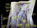 Iliopsoas