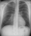 Mediastinal shift