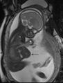 MRI of a fetus with pentalogy of Cantrell