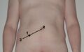 Anterior superior iliac spine
