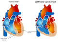 Ventricular septal defect