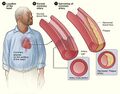 Atherosclerosis in coronary arteries