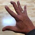 Broken_finger