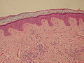Microscopic view of normal epidermis and dermis with intradermal nevus at 10x magnification.