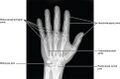 Broken_finger