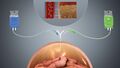 Diagram of peritoneal dialysis setup