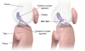 Image of an ACL tear
