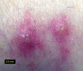 Trombiculosis sores