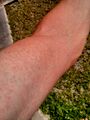 Zika virus rash on arm