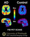 PiB PET Images in Alzheimer's Disease