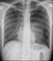 Spontaneous pneumothorax