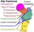 Classification of hip fractures