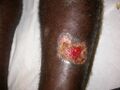 Cutaneous leishmaniasis