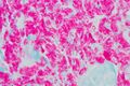 Mycobacterial infection in the duodenum
