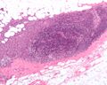 Sentinel lymph node