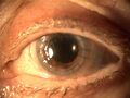 Penetrating keratoplasty