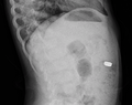 9mm battery in intestines lateral view