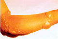 Blister arm