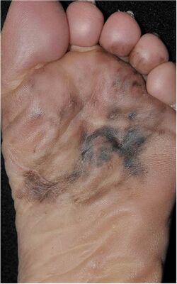 Photography of a large acral lentiginous melanoma