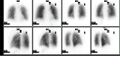 Ventilation/perfusion scan