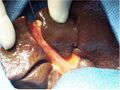 Hepatoportoenterostomy