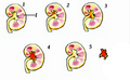 Staghorn Kidney Stone Progression