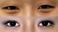 East Asian blepharoplasty before and after