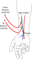 Diagram of a radiocephalic fistula