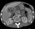 Cholangiocarcinoma
