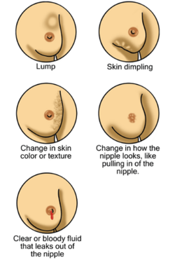 Breast cancer illustrations
