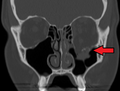 Fracture of the left orbital floor